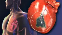 Ilustrasi atherosclerosis, penyumbatan pembuluh darah jantung. (Sumber webMD)
