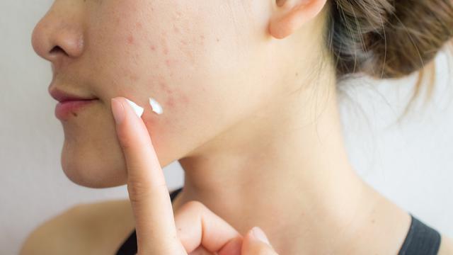 Terlalu Cepat Menyerah dengan Obat Jerawat