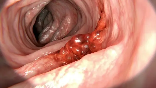 Kanker Kolorektal (Foto: Alomedika)