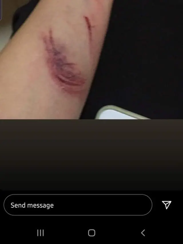 Gusti Rosaline Oca mengunggah foto bagian tubuhnya yang terluka dan mengalami memar cukup parah (Instagram Stories)