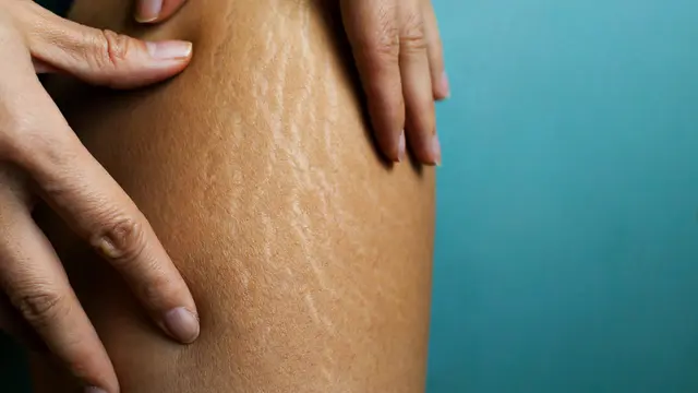 Ilustrasi stretch mark