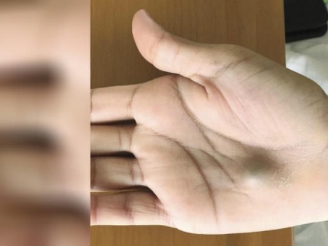 Temukan Benjolan Merah Di Telapak Tangan Segera Periksa Ke Dokter Citizen6 Liputan6 Com
