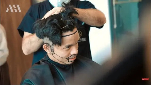 Akui Tak Percaya Diri, Ini 7 Potret Atta Halilintar Jalani Transplantasi Rambut