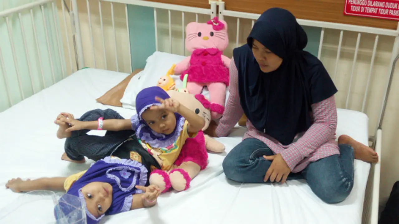 Bayi Kembar Siam di Bandung