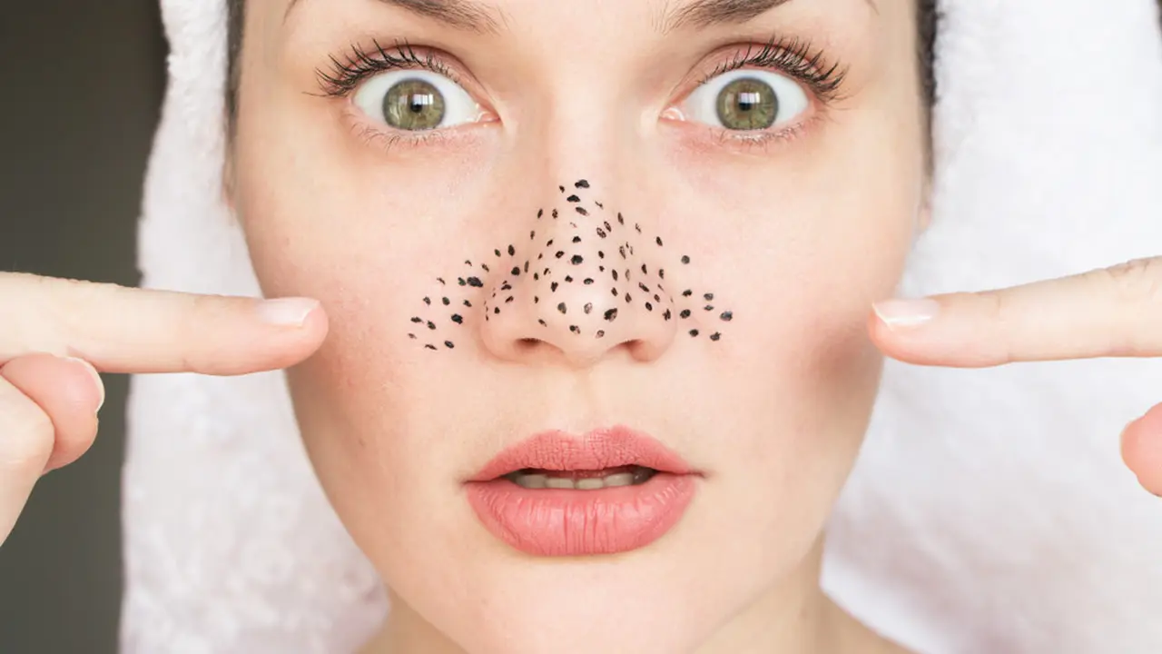 Terganggu Komedo Hitam di Hidung? Hilangkan dengan Perawatan Rumahan Ini