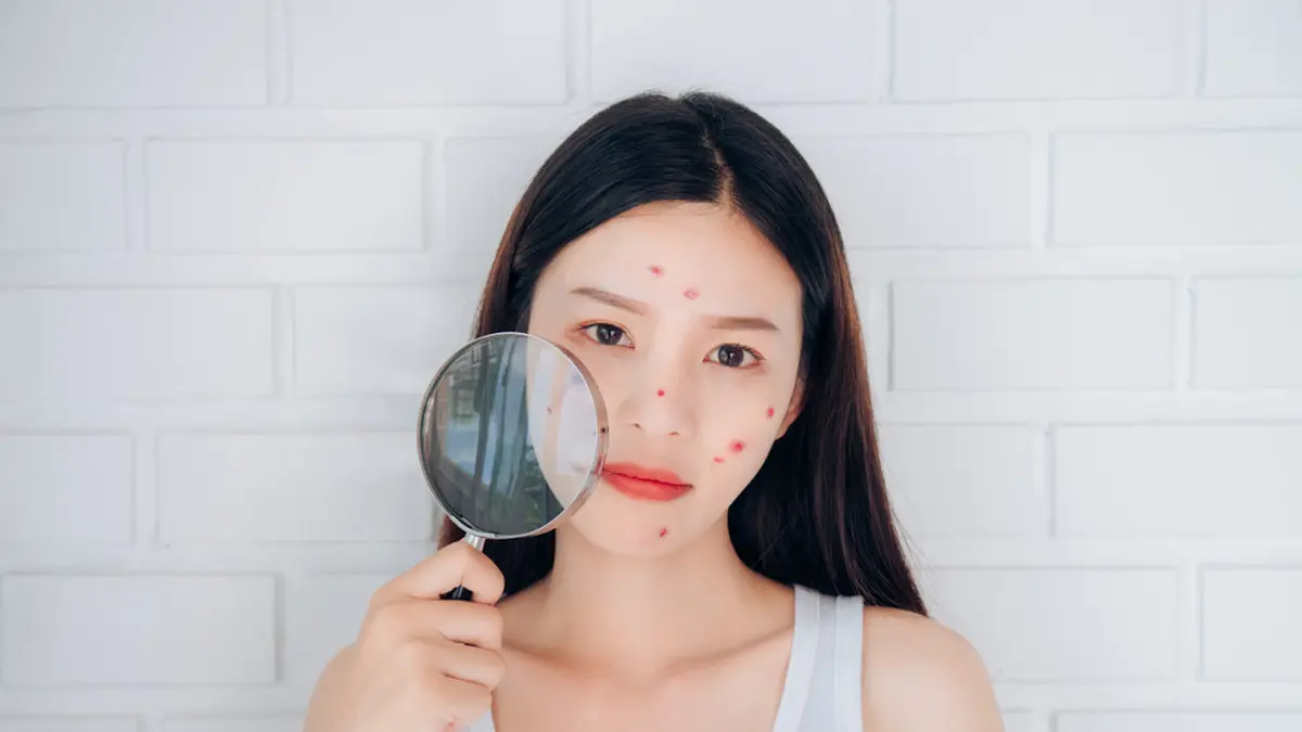 Jenis Perawatan Wajah Berjerawat Terbaru - Berita, Foto, Video | Fimela.com