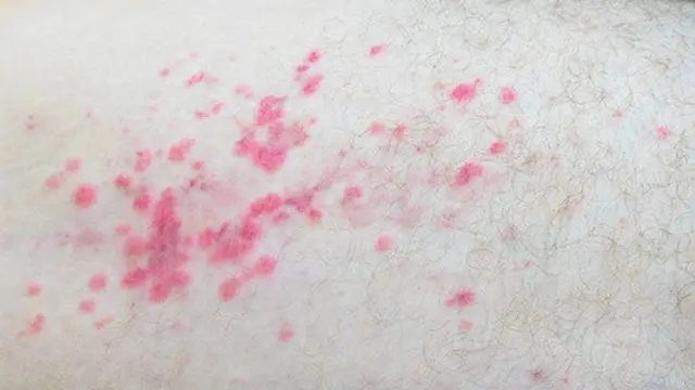 Akibat Melakukan Seks Bebas