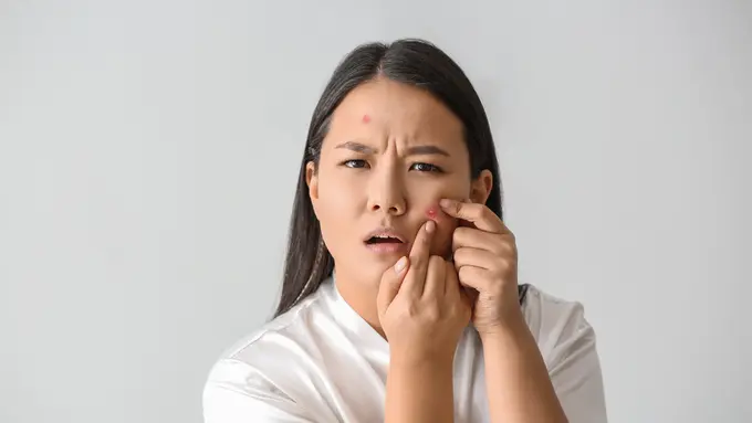 Tips Mengempeskan Jerawat Matang dengan Cepat tanpa Perlu Dipencet