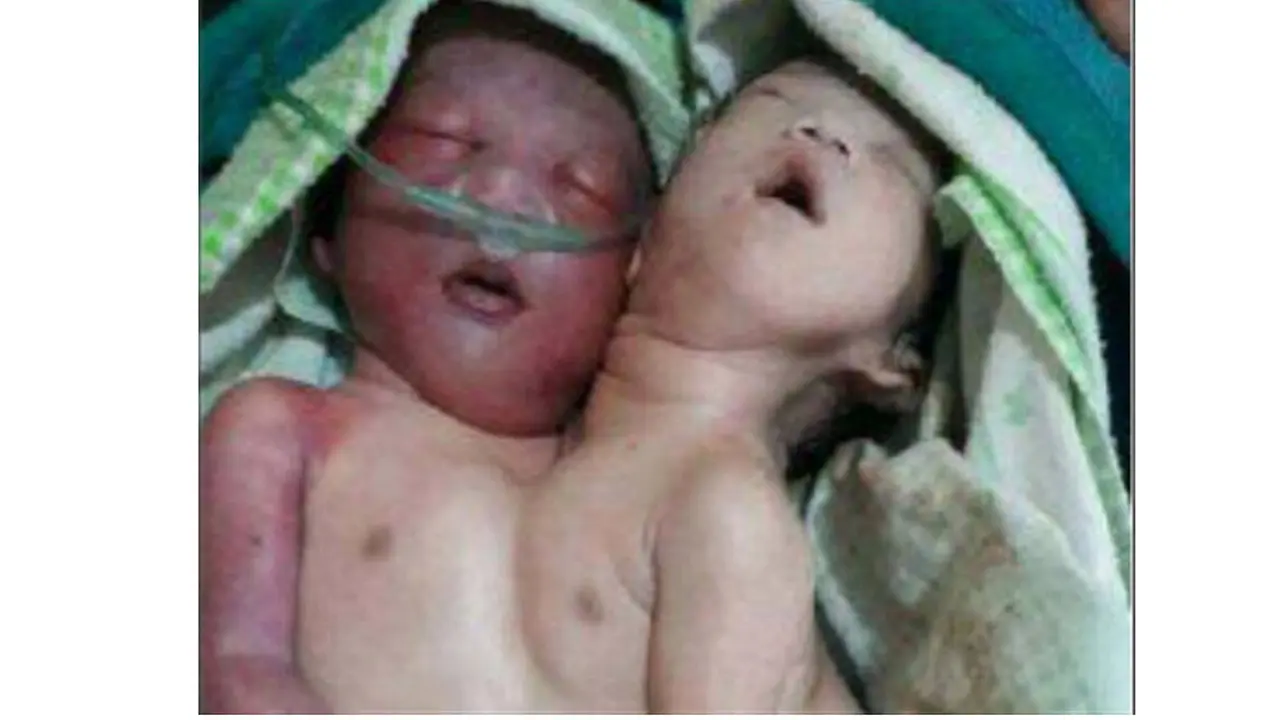 Bantu Ringankan Beban Biaya Bayi Kembar Siam