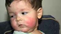 Ilustrasi alergi anak. Foto: CNN.com