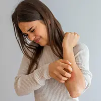 ilustrasi eksim/Dragana Gordic/shutterstock