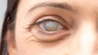 Tanda-Tanda Retinoblastoma pada Anak Sejak Dini