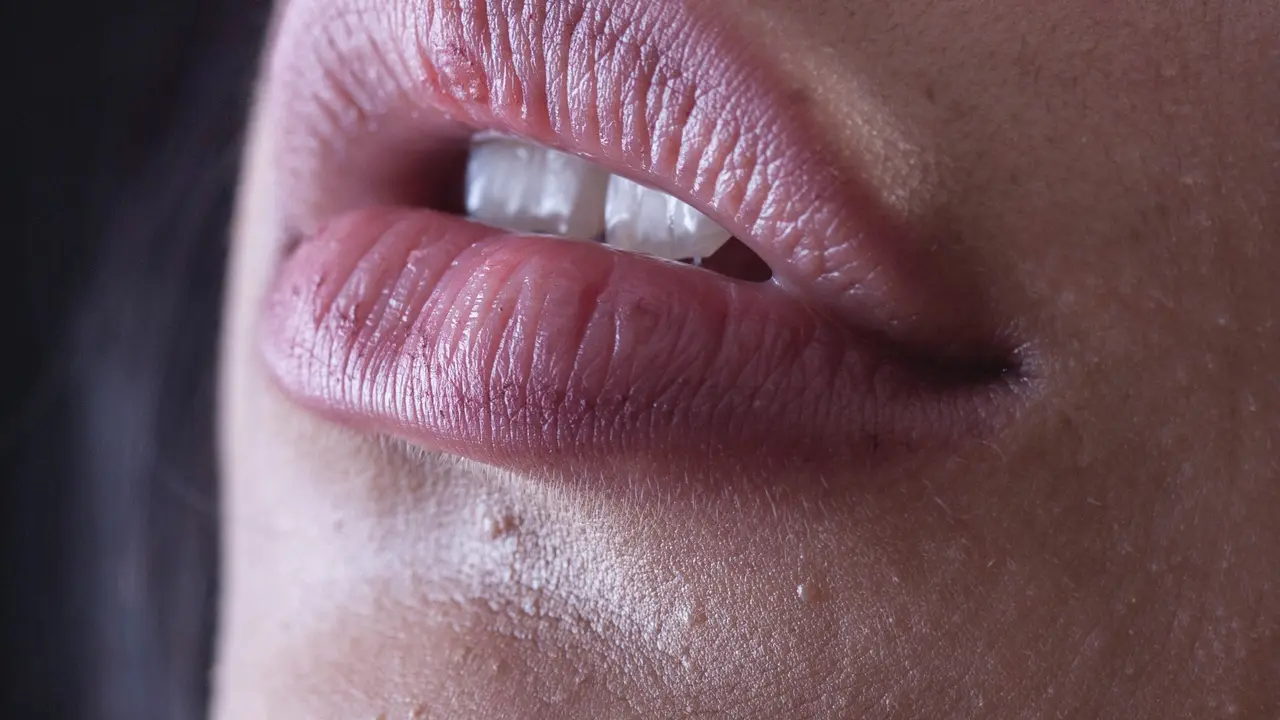 Intip cara ampuh untuk menghilangkan komedo membandel di pinggir bibir.