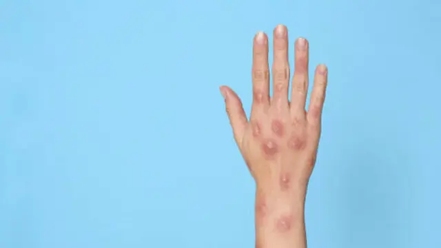 Vaksin seperti JYNNEOS dan ACAM2000 telah diharapkan memberikan perlindungan