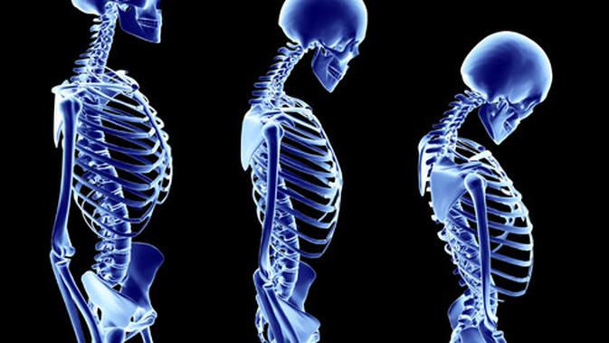 Gaya Hidup Tidak Aktif Rawan Terkena Osteoporosis