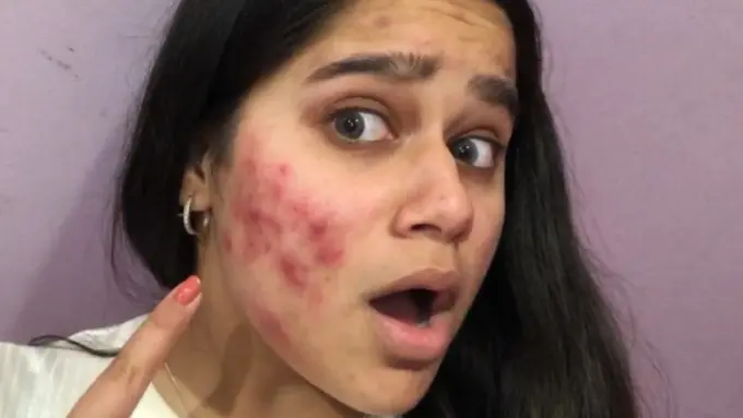 Jerawat Parah di Wajah Bisa Hilang Sekejap dengan Makeup Ini