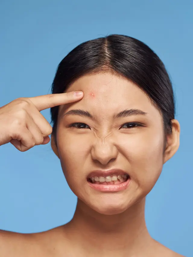 Tips Mengempeskan Jerawat Matang dengan Cepat tanpa Perlu Dipencet