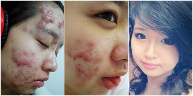 Untuk emnutupi masalah jerawat, Elaine menggunakan makeup. (c) saoonline.vn, youtube.com