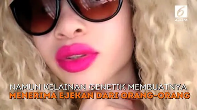 Namun kelainan genetik membuatnya menerima ejekan dari orang-orang.