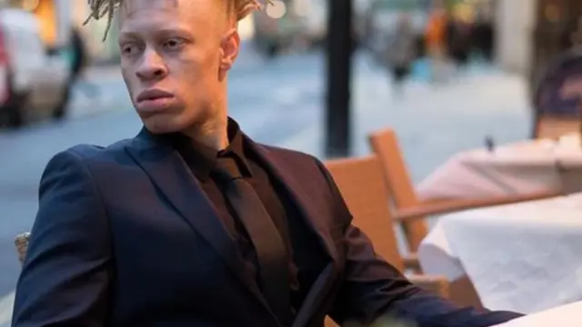 [Bintang] Saat Kecil Selalu Jadi Korban Bully, Kini Pria Albino Sukses Berkarier di Dunia Modelling