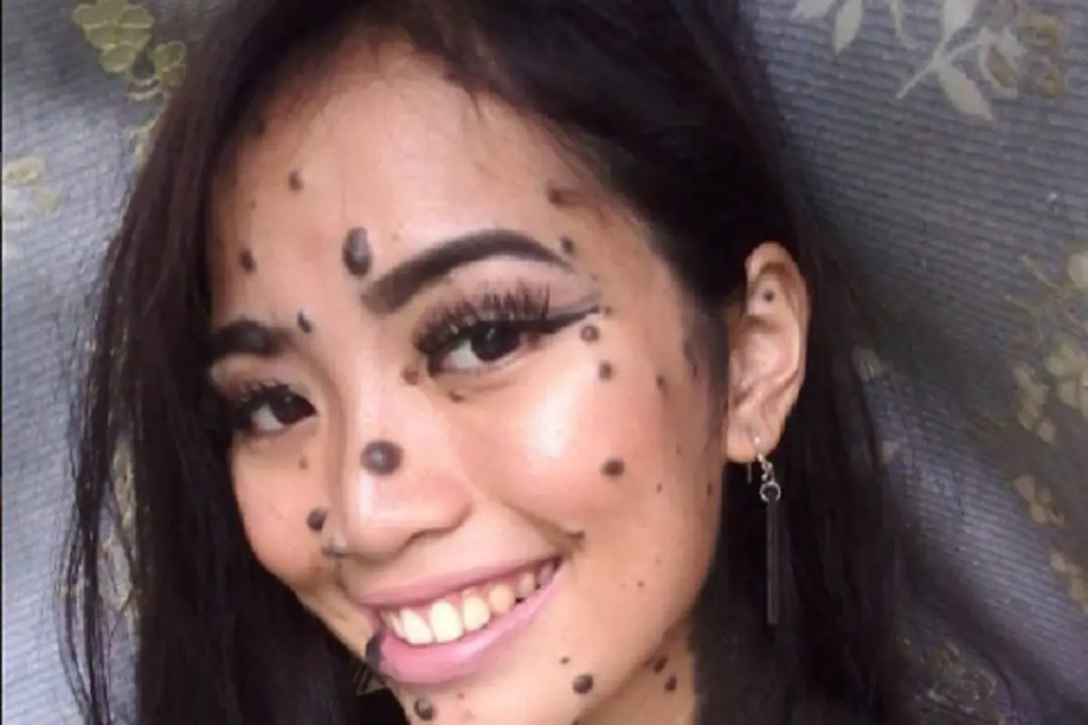Tahi Lalat Seluruh Tubuh, Wanita Ini Dibuli Ikut Ajang Kecantikan