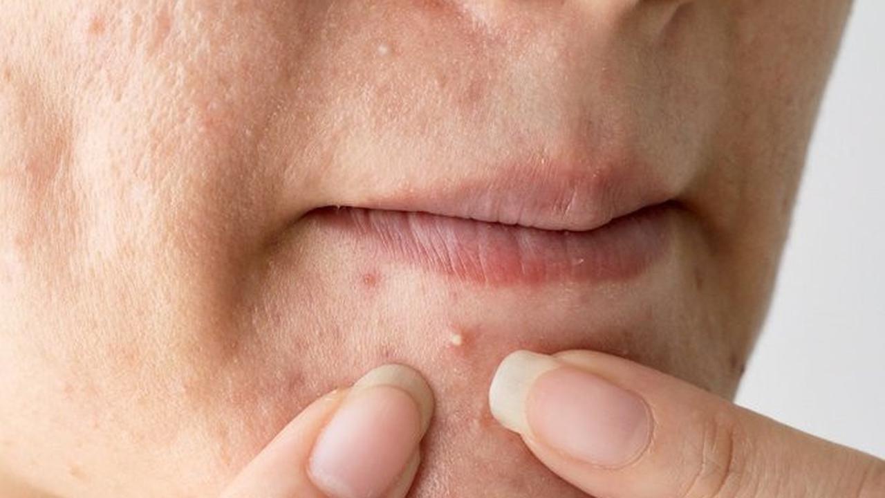 Ilustrasi Jerawat Whitehead | insider.com