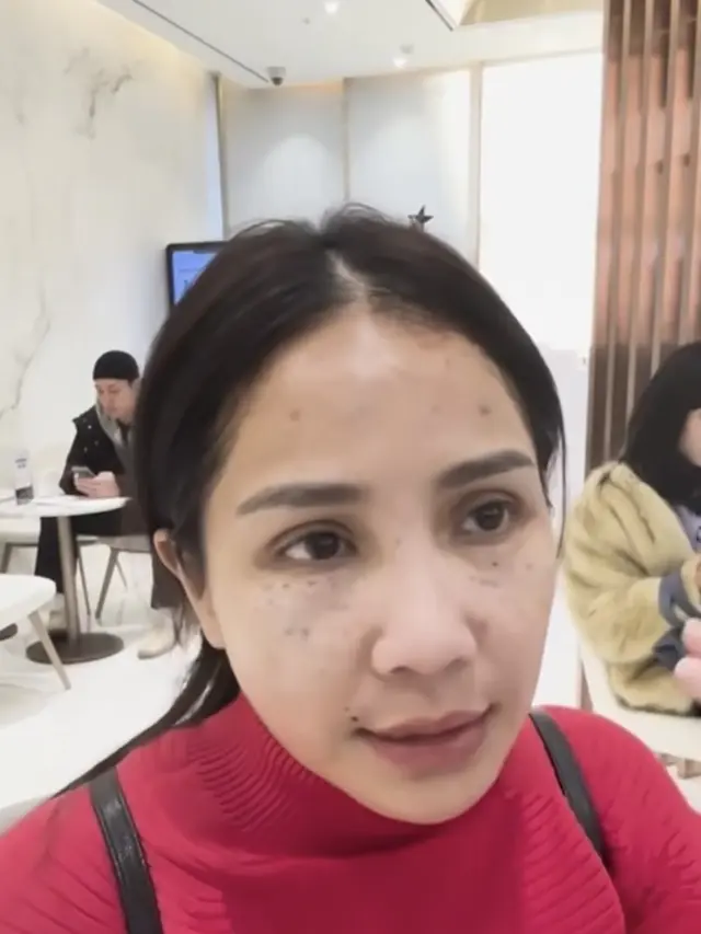 Wajah Bengkak Nagita Slavina Setelah Perawatan di Korea Selatan. [@raffinagita1717]