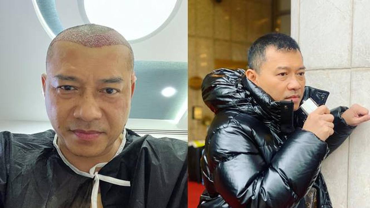 Dikira Raul Lemos, Ini 6 Potret Anang Hermansyah Usai Transplantasi Rambut di Turki