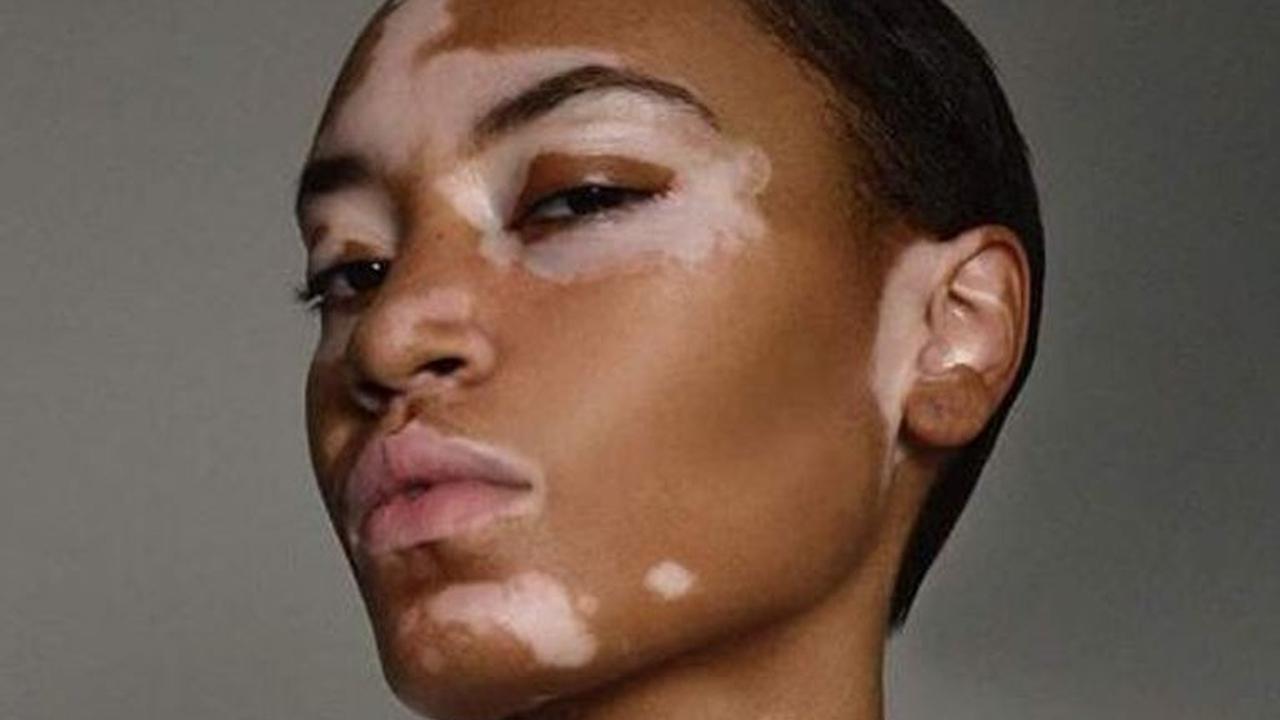 [Bintang] Menderita Vitiligo, Amy Deanna Berhasil Jadi Model yang Mendunia