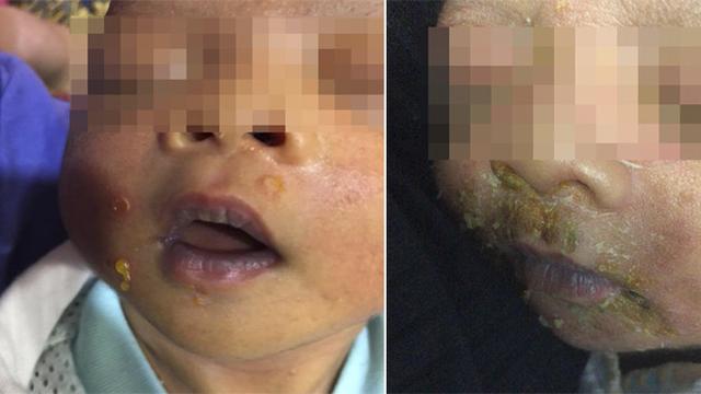 Balita Terinfeksi Penyakit Kulit Setelah Disentuh Kerabat