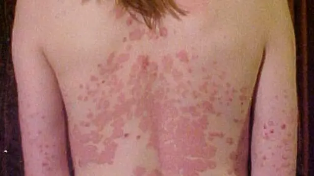 Psoriasis eritrodermik