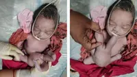 Bayi di India Lahir dengan Empat Kaki dan Empat Tangan, Dianggap Reinkarnasi Tuhan