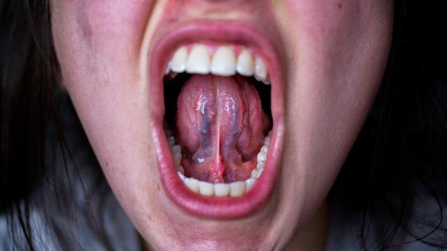 Mengenal Penyebab Cadel