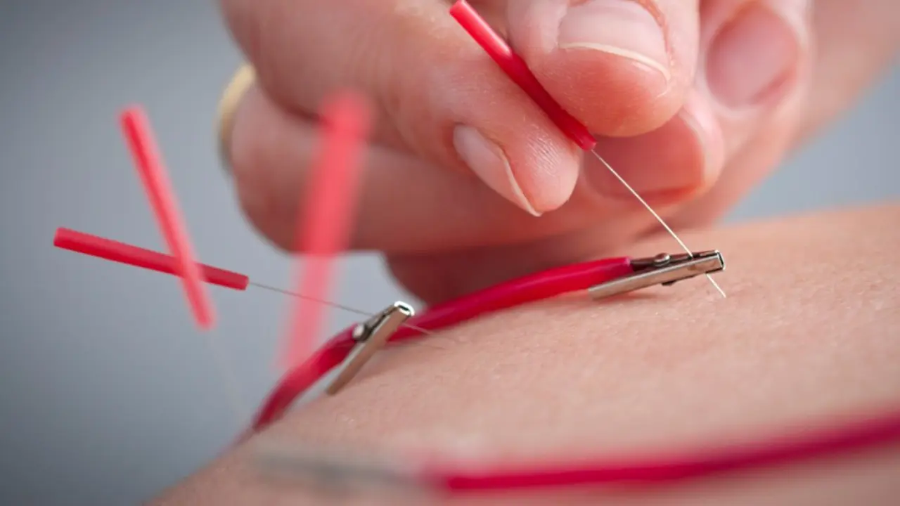 Elektroakupunktur bisa membantu melancarkan sembelit alias susah buang air besar. (Foto: floridainstituteofacupuncture.com)