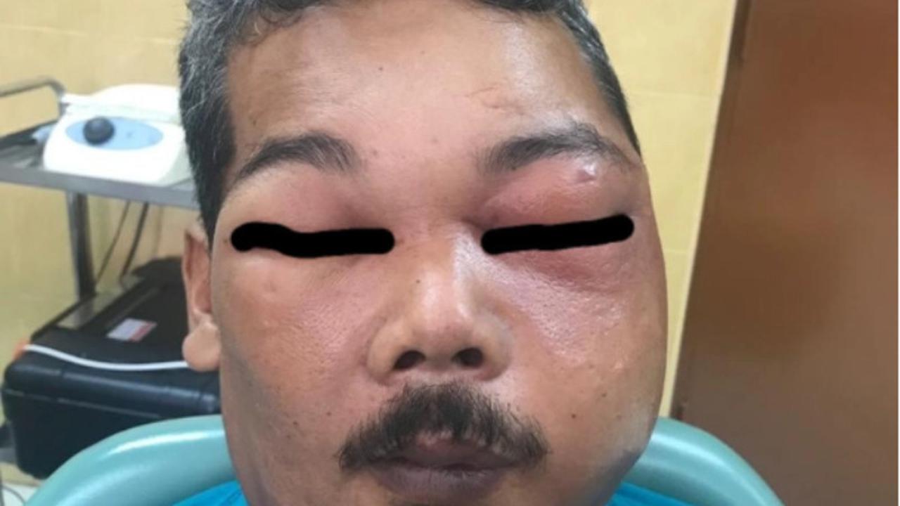 Pakai Minyak Rem Obati Gigi yang Sakit, Ini yang Terjadi