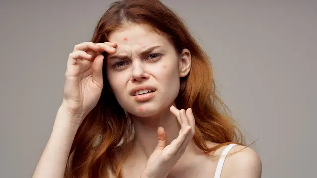 Tips Mengempeskan Jerawat Matang dengan Cepat tanpa Perlu Dipencet