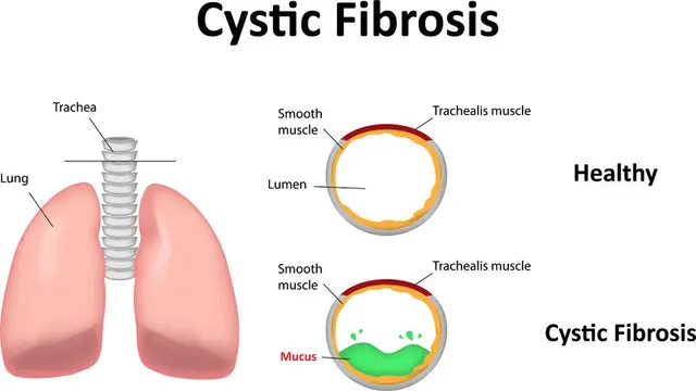 Cystic Fibrosis