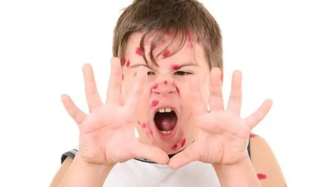 7 Cara Efektif Mengobati Cacar Air pada Anak Dengan Bahan Rumahan