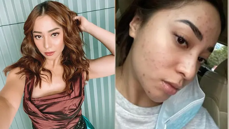 Unggah Foto Berjerawat, Ini 6 Potret Nikita Willy Tampil Natural