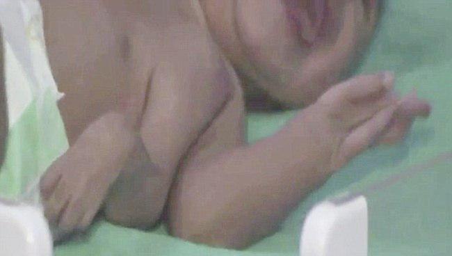 Tangan tambahan pada bayi yang disebut polymelia | foto: copyright dailymail.co.uk