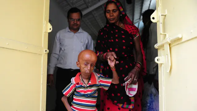 20170502-Rupesh, Pasien Progeria di India-AFP