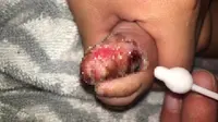 Jari kaki bayi dicium sembarangan dan terkena virus herpes. Source: Facebook /Pregnancy Corner