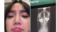 Fuji An Sedih Setelah Didiagnosis Skoliosis dan Mengetahui Tulang Belakang Miring. Skoliosis Adalah Kondisi Tulang Belakang Mengalami Kemiringan Sehingga Membentuk Huruf S atau C (instagram.com/fuji_an)