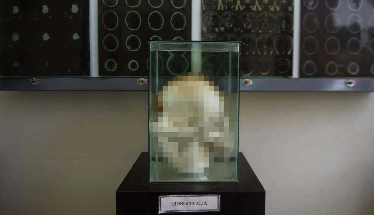 Sebuah janin diawetkan di Museum Neuropatologi, di Rumah Sakit Santo Toribio de Mogrovejo, Lima, Peru (16/11). (AFP Photo/Ernesto Benavides)