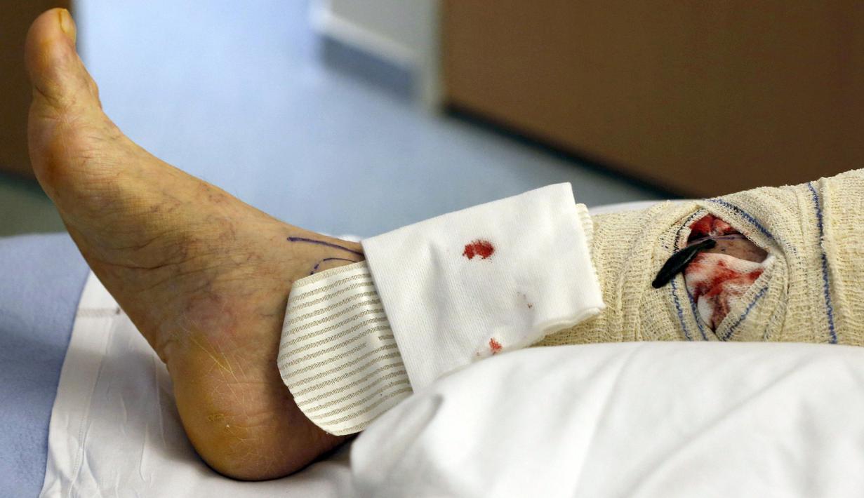 Lintah ditempatkan pada bagian kaki yang mengalami sakit saat terapi di rumah sakit CHU Pellegrin, Bordeaux, Prancis, (23/11). Lintah untuk terapi ini menggunakan lintah jenis Hirudo Medicinalis. (REUTERS / Regis Duvignau)