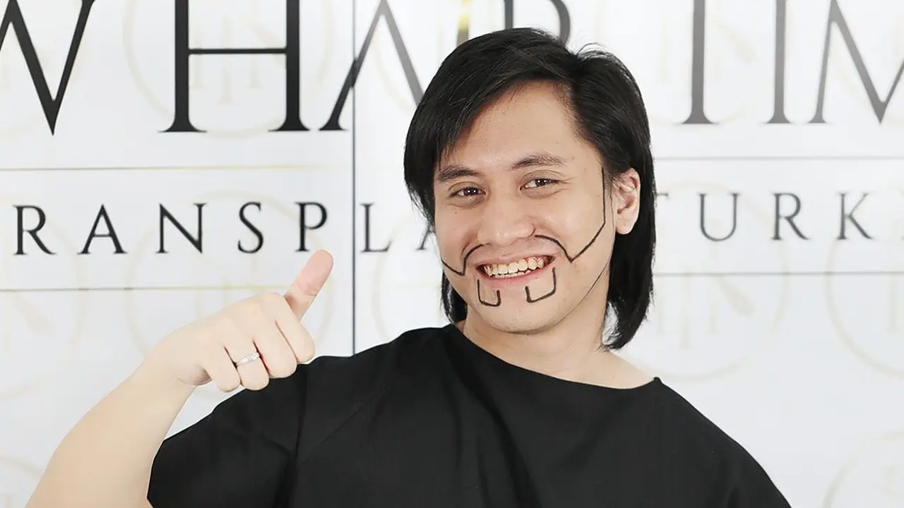 Potret Kevin Aprilio Jalani Transplantasi Rambut. (Sumber: Instagram/now.hairtime)