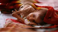 Seorang anak penderita malnutrisi di Yaman (Hani Mohammed/AP)