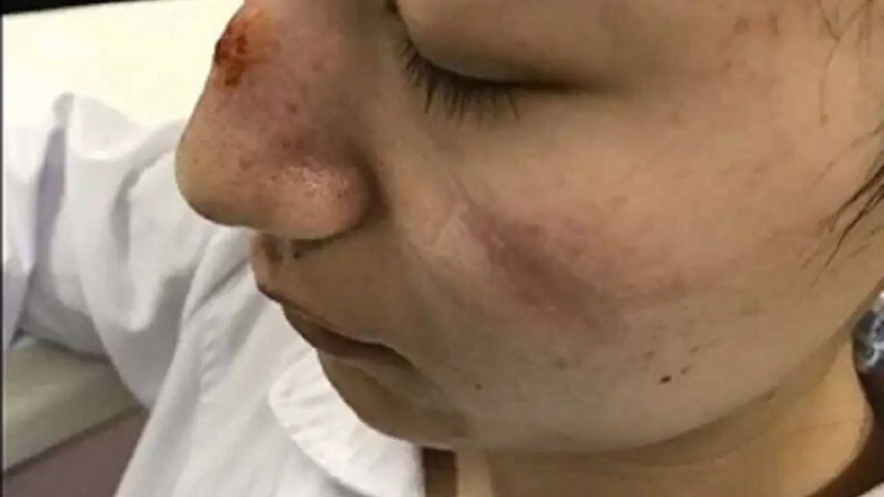 7 Potret Luka Lebam di Wajah Tim Medis Akibat Kacamata Pelindung Selama Perangi Virus Corona
