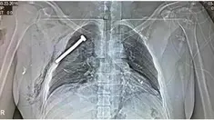 Gambar sinar X-ray ini menunjukkan ada sekrup berukuran besar tertanam di dada korban serangan teror bom Brussels yang terjadi di stasiun metro dan bandara Zaventem pada Selasa, 22 Maret, lalu.