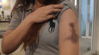 Korban penganiayaan Polwan di Pekanbaru memperlihatkan luka lebam yang ada pada lengannya. (Liputan6.com/M Syukur)